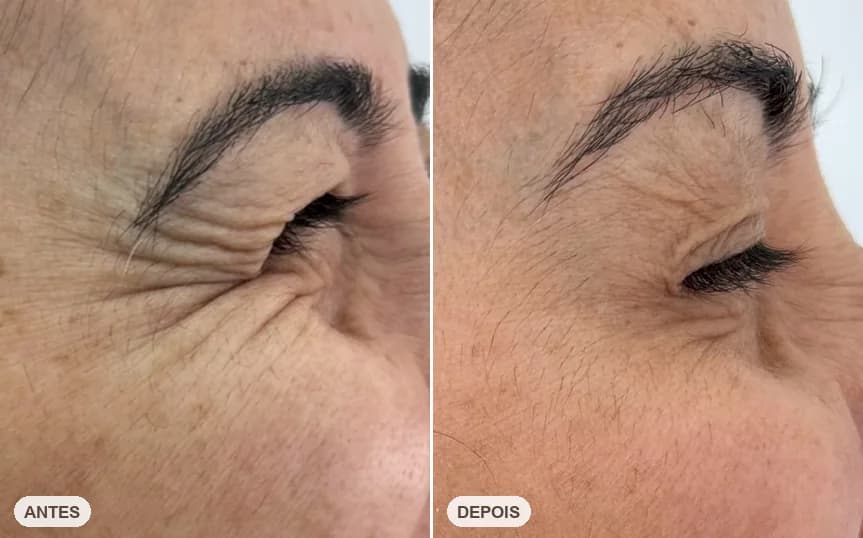 Resultado de paciente da Dra. Lorena Leão — caso 10, antes e depois