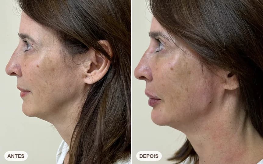Resultado de paciente da Dra. Lorena Leão — caso 6, antes e depois